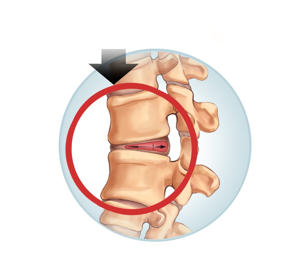 Sciatic Nerve Pain – Bulging Disc – BeatingBackPain